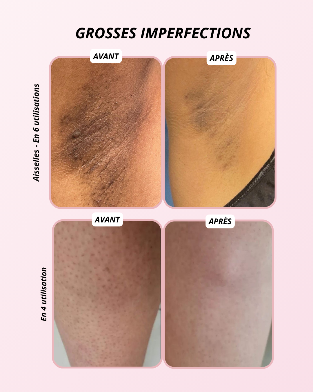 Coffret Anti-Imperfections - Corps