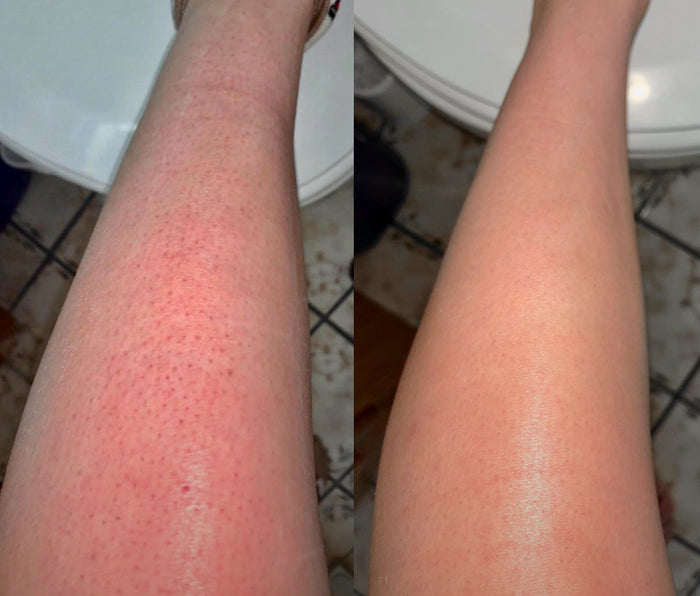 Peau de fraise